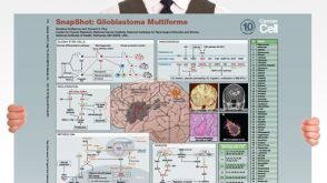 SnapShot: Glioblastoma Multiforme