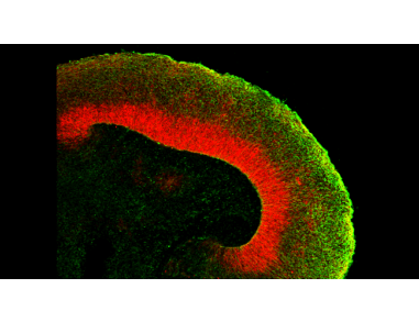 Brains in a Dish: Using Cerebral Organoids to Study Human Brain Development and Disease
