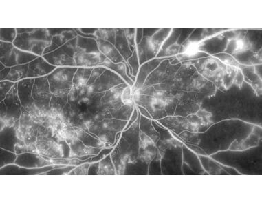Therapeutic Application of Endothelial Colony-Forming Cells for Retinal Diseases